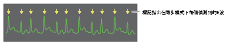 Defibrillator Cardioversion R Wave