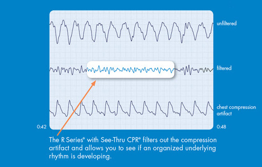 An unfiltered waveform with the underlying filtered waveform and chest compression artifact separated out 